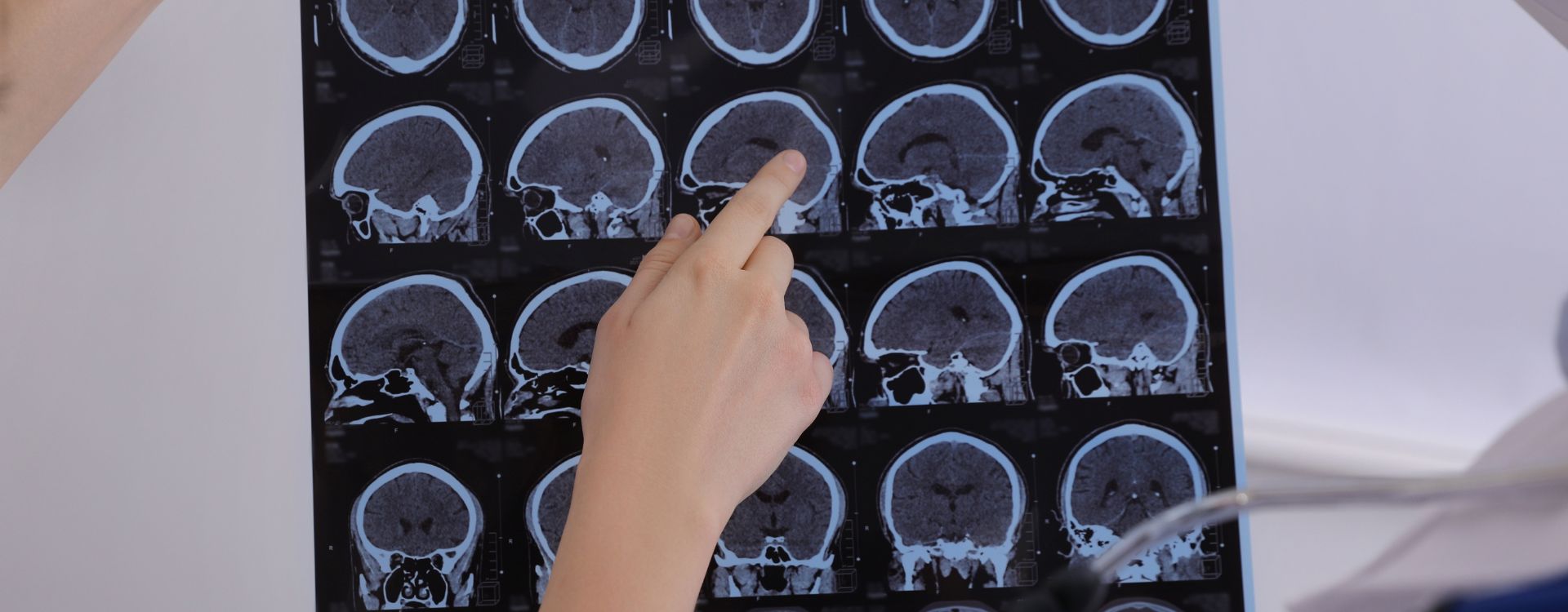 sclerosis